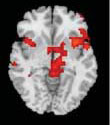 Image of a hoarder's brain activation.
