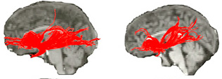 Image of normal brain scan vs. Williams syndrome.