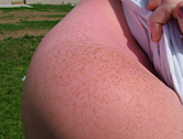Sunburn on the shoulder