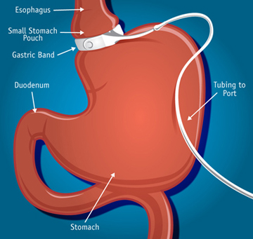 FDA Targets Gastric Band Weight-Loss Claims - (JPG 2)