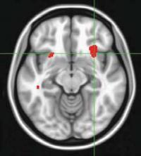  Image of brain scan used in the study
